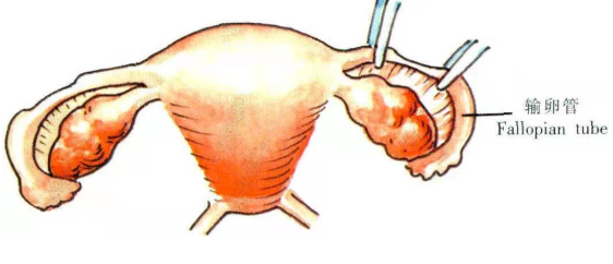 可选择输卵管复通术,它适用于输卵管结扎,输卵管夹,套环,电凝等绝育术